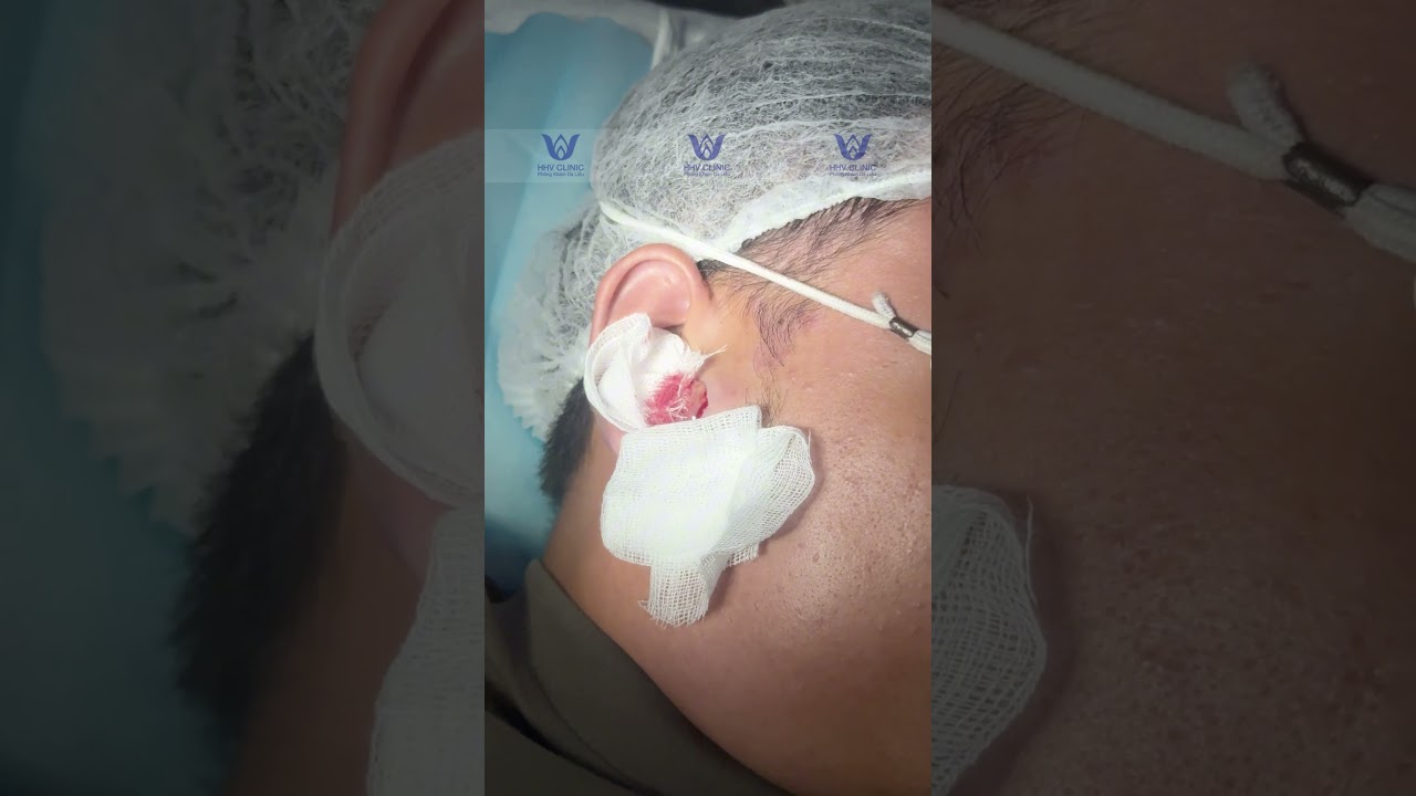 Mụn Áp Xe Dưới Tai Sưng To Bất Thường.