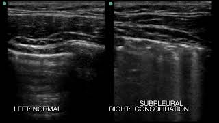 Pulmonary Contusion On Lung Ultrasound Teen Snowboarder Collided With Tree