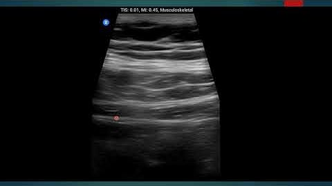 Subcostal TAP Block Ultrasonography in 1 Minute