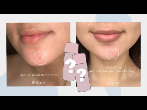 Review Loria Acne Lotion Kita