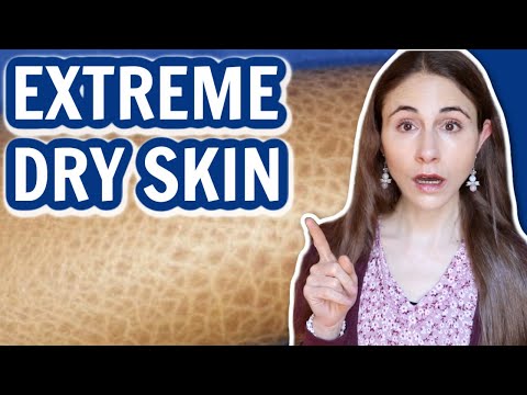 SIGNS OF EXTREME DRY SKIN // ICHTHYOSIS VULGARIS @Dr Dray