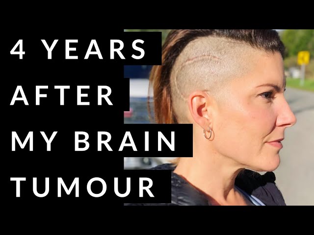 4 years After My Brain Tumour