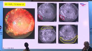 AIOC2024  GP91 Topic  Dr Ajay Aurora Widefield imaging in diabetic