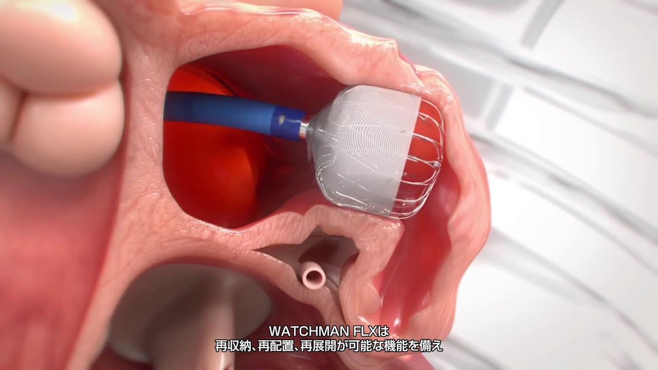 経皮的左心耳閉鎖術 （WATCHMAN™） | 診療科・センター・部門