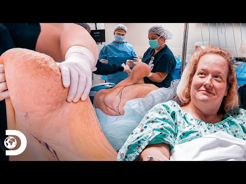 Vídeo: Mulher Que Perdeu 350 Libras. Corpo Envergonhado Na Praia Novamente - Mesmo Após Cirurgia De Remoção De Pele