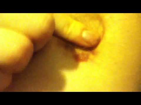 squeaky-armpit-infection