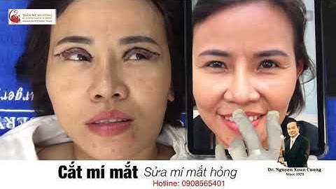 SỬA MÍ HỎNG  - CẮT MÍ HỎNG - SỬA MÍ MẮT HỎNG - SỬA MÍ MẮT_GS.TS.BS Nguyễn Xuân Cương