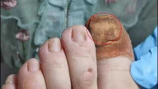 How to treat fungus nails. Fungal nail treatment &amp; ingrown toenails removal.
