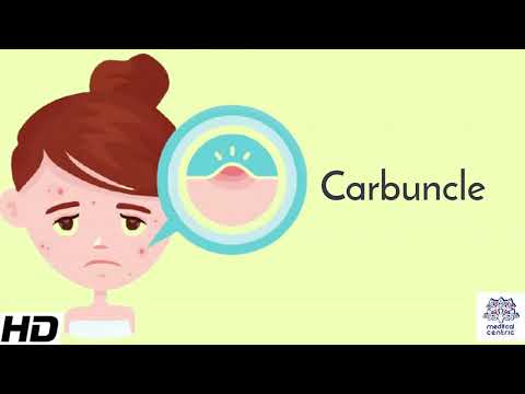 Video: Carbuncle - Uzroci, Faze I Liječenje