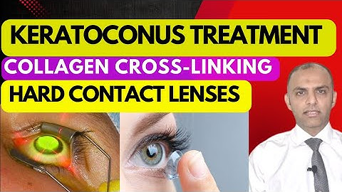 What is Keratoconus ? Understanding the Condition and Its Impact on Vision #drfaisalanwar