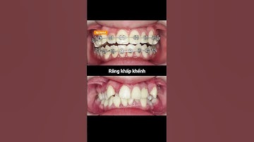 Cận cảnh quá trình thay đổi răng lệch lạc mức độ 2