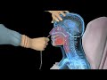 NG intubation (Inserting a nasogastric tube) - 3D medical animation