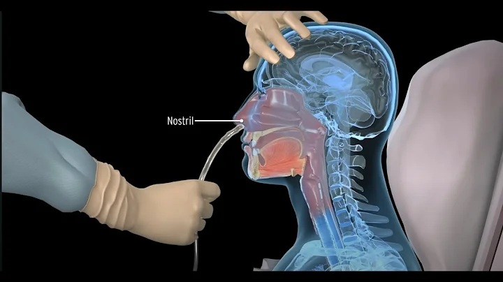 How to insert a nasogastric tube for NG intubation - 3d animation