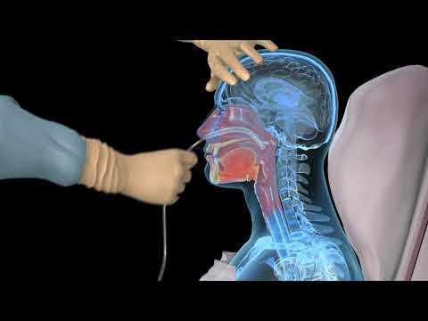 NG Intubation (Inserting a nasogastric tube) - 3D medical animation