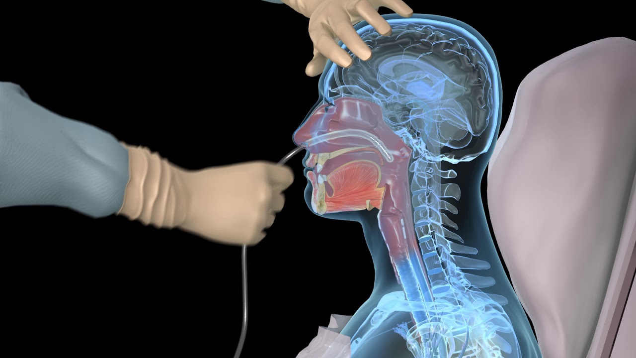 NG Intubation (Inserting a nasogastric tube) - 3D medical animation