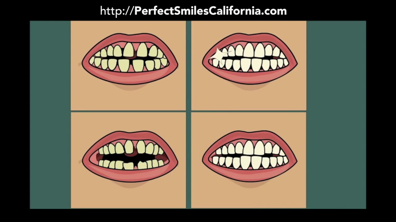 Chula Vista CA: Affordable Dental Veneers by Cosmetic Dentist