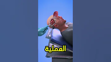 لماذا ت جرى عمليات جراحة الدماغ بينما يكون المريض في حالة وعي تام 