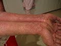 Treatment of eczema and other skin diseases