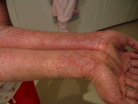 Video: 3 Mga Paraan upang Gamutin ang Winter Eczema