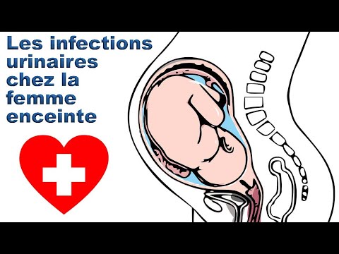 Vidéo: Urine Trouble Pendant La Grossesse: Causes, Diagnostic, Traitement Et Plus