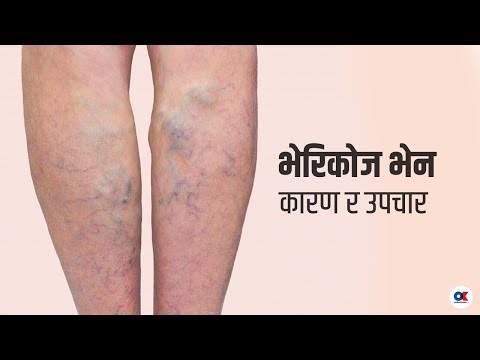गृहिणीदेखि कामकाजी व्यक्तिमा देखिन सक्छ भेरीकोज भेन । Dr. Manish Thapa । Varicose Vein