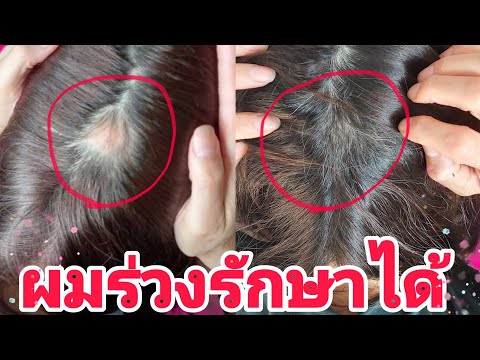 ผมร่วงรักษาได้ง่ายๆ Ep.41 #ผมร่วง #ผมร่วงเป็นหย่อม #ผมบาง #หัวล้าน
