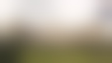 Robotic Radical Nephrectomy in Right wilms tumour by Dr Sujit Chowdhary, Pediatric Urologist