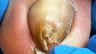 Two Feet - Toenails Are Curled At The Front!【Xue Yidao】