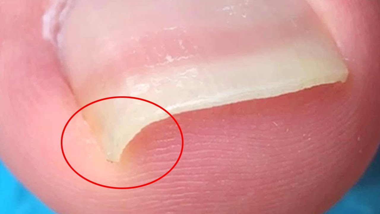 The tip of the toenail is embedded with a sharp corner!【Crazy pedicure