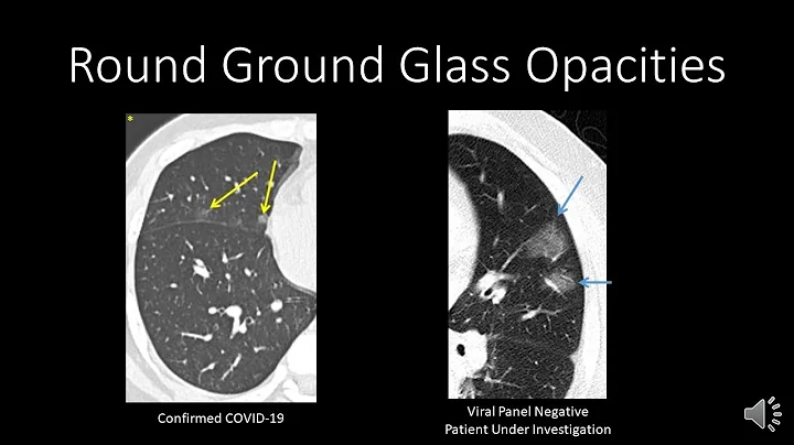 COVID-19: CT Findings - DayDayNews