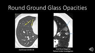 COVID-19: CT Findings