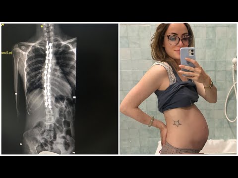 PREGNANCY AND SCOLIOSIS SURGERY - MY EXPERIENCE