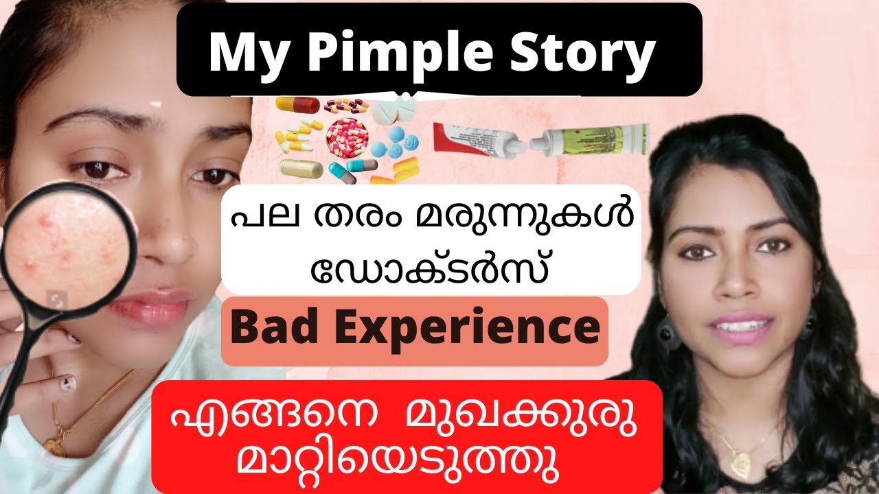 മുഖക്കുരു മാറ്റിയെടുത്തത് എങ്ങനെ എന്റെ ദുരനുഭവങ്ങൾ My Story