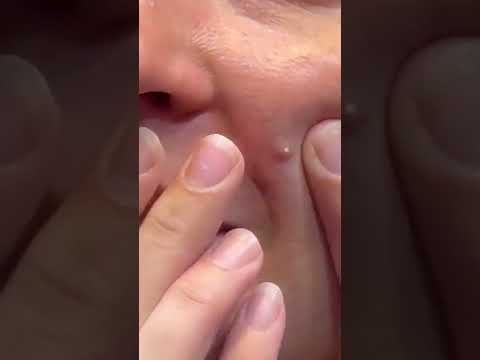 How To Get Rid of Acne Scars & Blackheads 4K