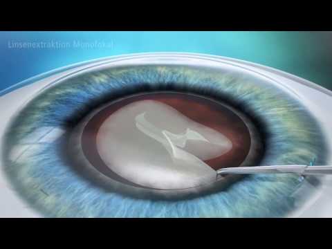 Video: 3 Möglichkeiten, Katarakte mit einer Operation zu behandeln