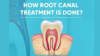 How root canal treatment is done?