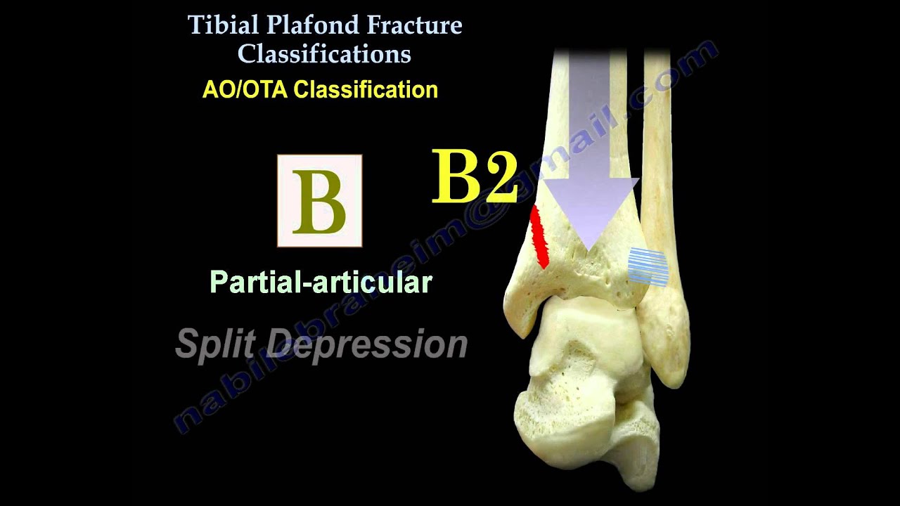 pilon fracture tibial plafond fracture everything you need to tibial plafond