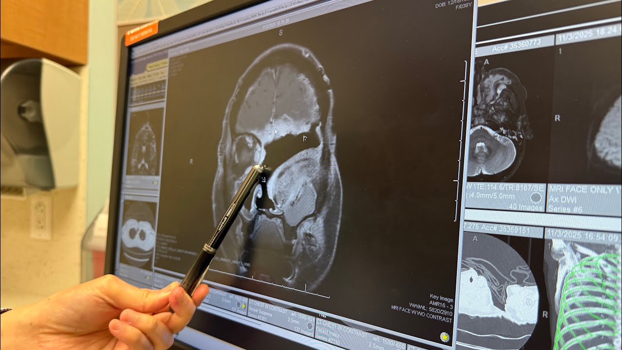 Обновленная информация о росте рака и потенциальных клинических испытаниях