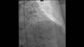 Coronary Steal Syndrome After CABG