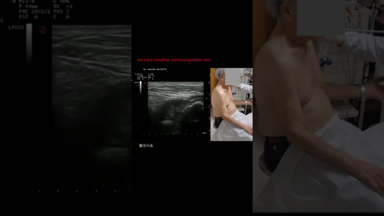 lesione completa del tendine sottoscapolare della spalla sinistra