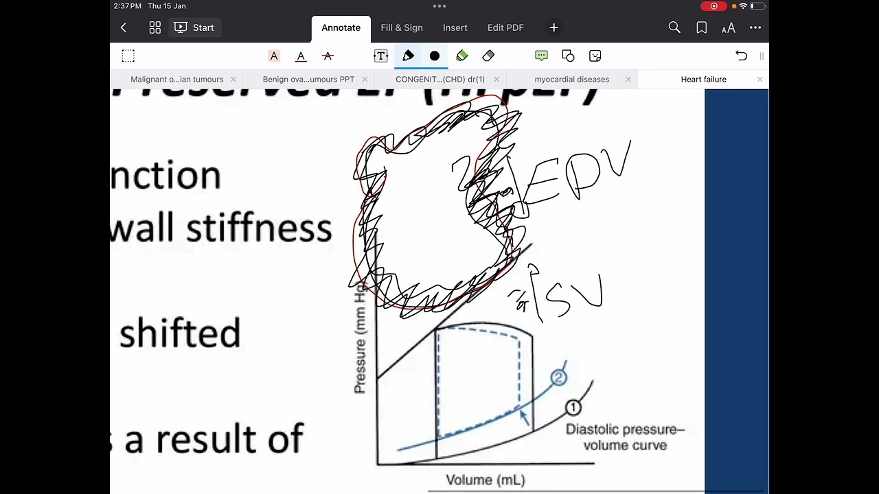 Heart failure with preserved ejection fraction 
