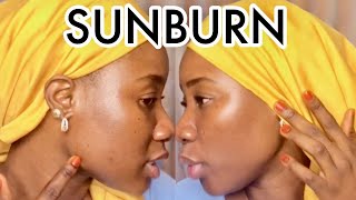 Sunburn Treatment For Black Skin | How To Clear Sunburn Fast!