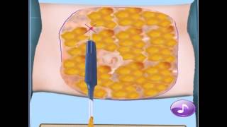 Liposuction Surgery Simulator Android Game screenshot 3