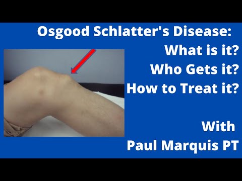 Video: Osgood Schlatterjeva Bolezen - Zdravljenje, Diagnoza