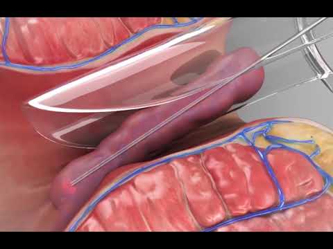 Video: Hemoroidin kiçilməsinin 3 yolu