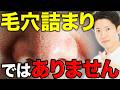 毛穴の黒ずみ、それ詰まりじゃないんです！皮脂フィラメントの真実と正しいケア