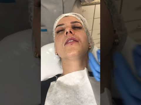 Preenchimento labial