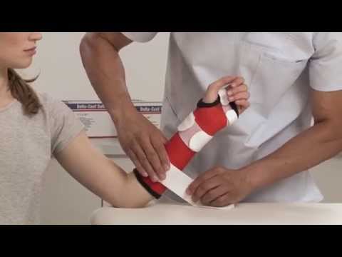 Delta-Cast Soft Removeable Short Arm Cast Application