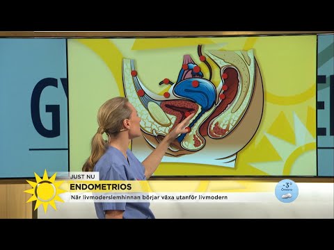 Video: Äggstocksendometrios - Symtom, Behandling Och Orsaker