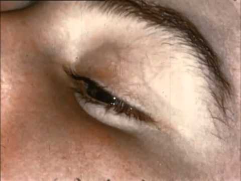 How To Evert The Upper Lid 1947 Youtube